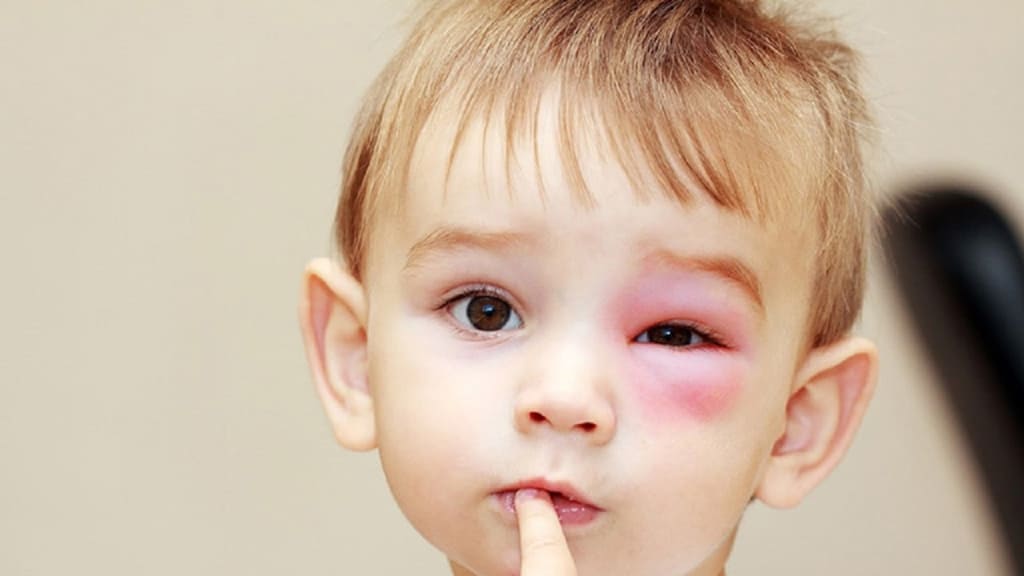 Nhiễm trùng quanh ổ mắt có thể dẫn đến xuất huyết dưới da ở trẻ