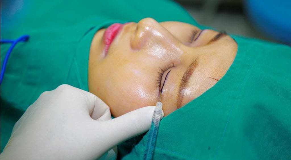 Phẫu thuật cắt mí giúp duy trì hiệu quả lâu dài