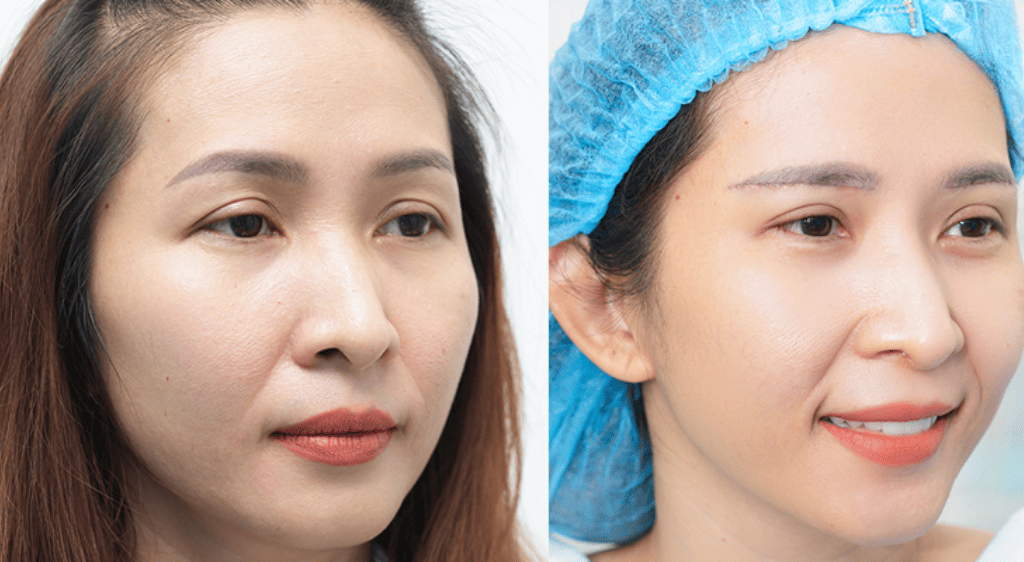 Phương pháp treo cơ nâng mi cải thiện đáng kể thần thái của khuôn mặt