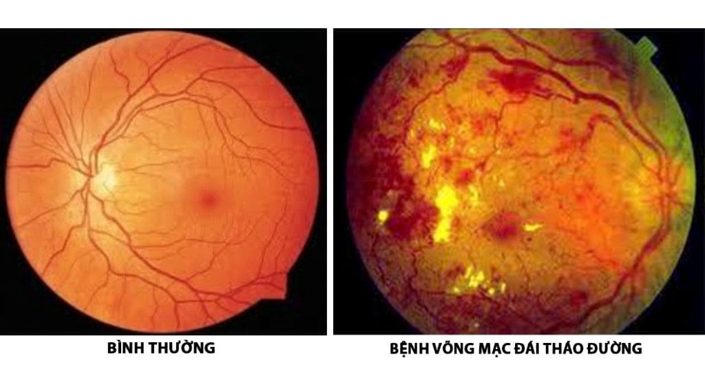 So sánh mắt người bình thường và mắt của người bị phù võng mạc bằng OCT