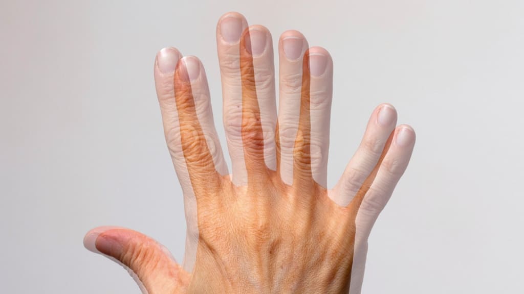 Song thị có thể gặp trong một số trường hợp tăng huyết áp nặng, nhưng không phải là triệu chứng đặc hiệu.