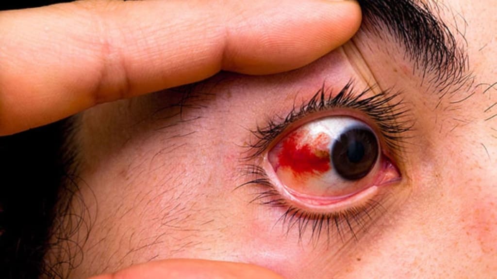 Tăng huyết áp ác tính gây ra xuất huyết võng mạc nặng, phù gai thị và các tổn thương sợi thần kinh