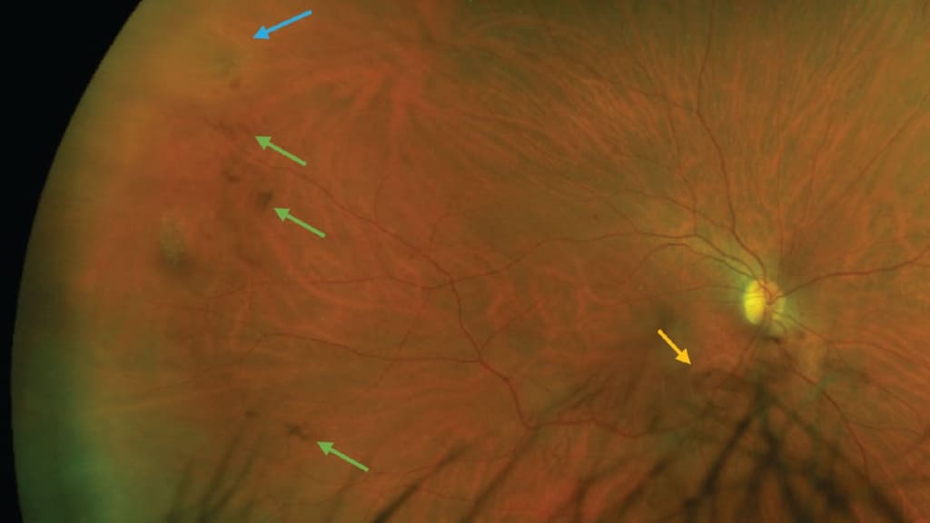 Tăng sinh dịch kính có thể dẫn đến mất thị lực hoặc mù lòa vĩnh viễn