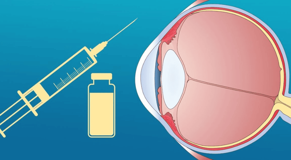 Tiêm nội nhãn Anti-VEGF giúp ức chế mạch máu bất thường, giảm phù hoàng điểm