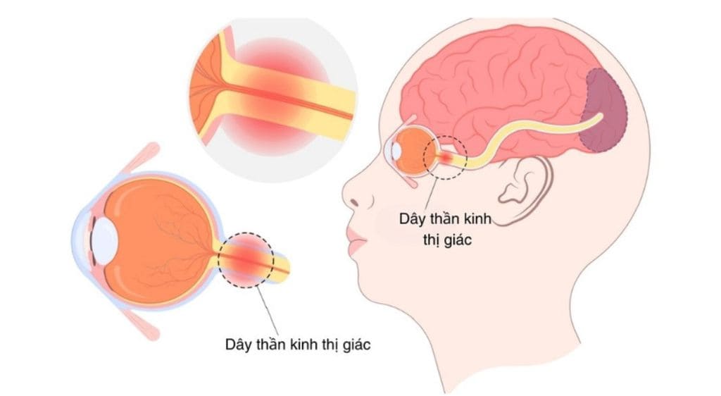 Tình trạng viêm làm tổn thương trực tiếp bao myelin và sợi thần kinh thị giác