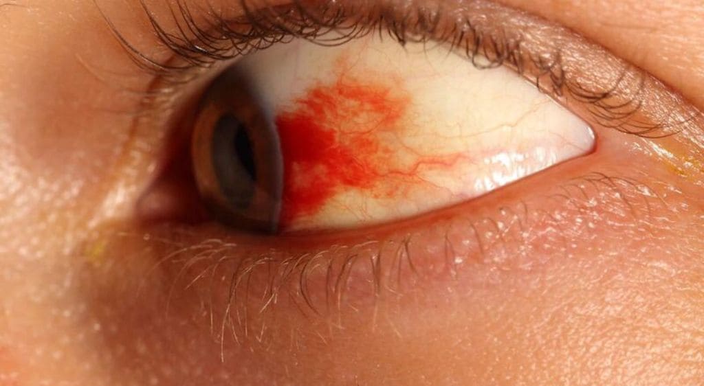 Tình trạng xuất huyết mắt lành tính có thể tự tan