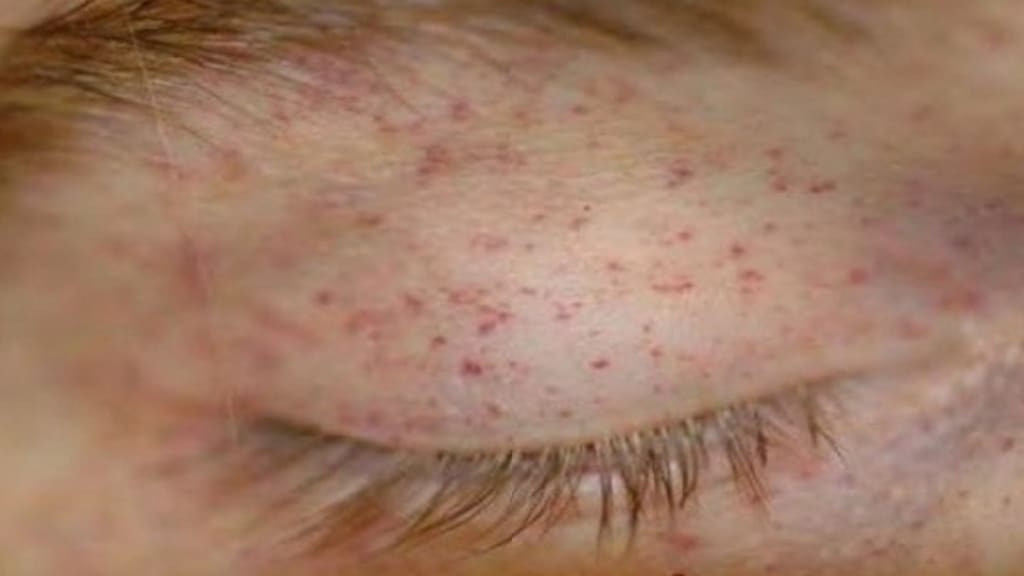 Trẻ em bị xuất huyết dưới da quanh mắt do các mao mạch bị vỡ dưới da