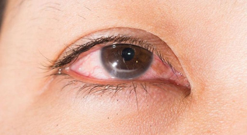 Triệu chứng có thể mỏi mắt sau khi chụp đáy mắt