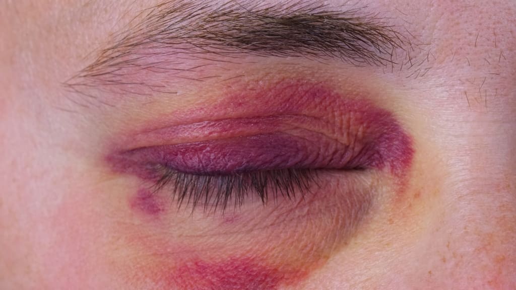 Tụ máu quanh hốc mắt có thể tự cải thiện sau 1-2 tuần