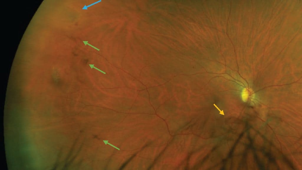 Vẩn đục dịch kính là sự ngưng tụ của các sợi collagen thành những mảng trôi lơ lửng