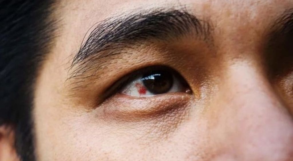 Vỡ mạch máu mắt lành tính có thể tự hồi phục