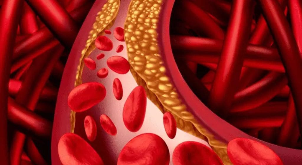 Xơ cứng và lão hóa mạch máu là một trong các nguyên nhân dẫn đến xuất huyết ở mắt