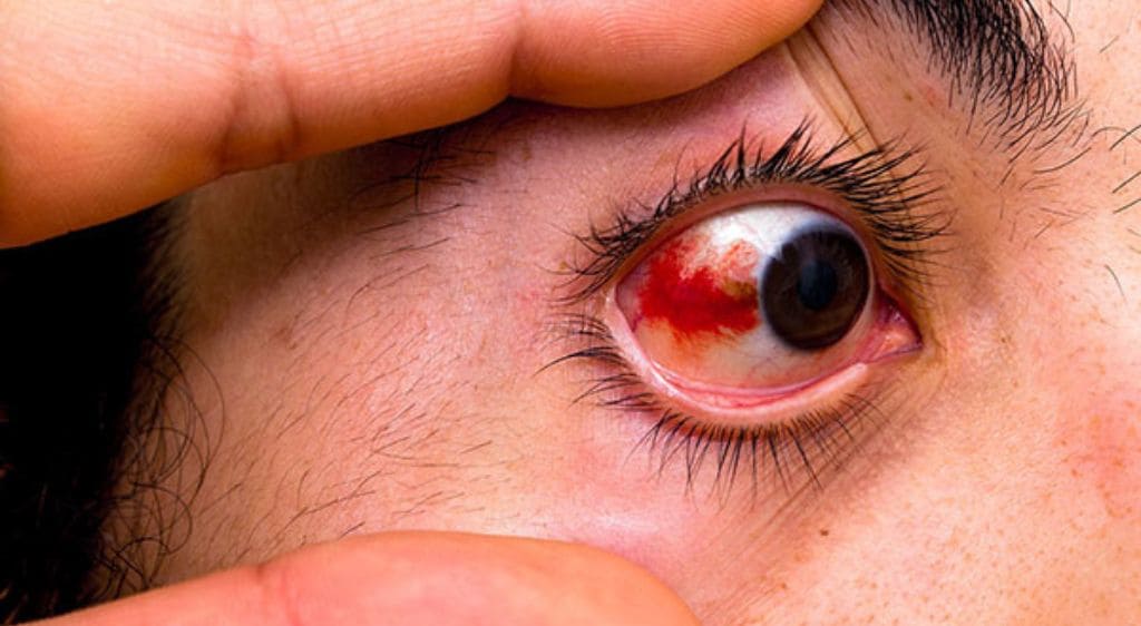 Xuất huyết mắt ở người già khiến bệnh nhân cảm thấy lo âu khi gặp phải