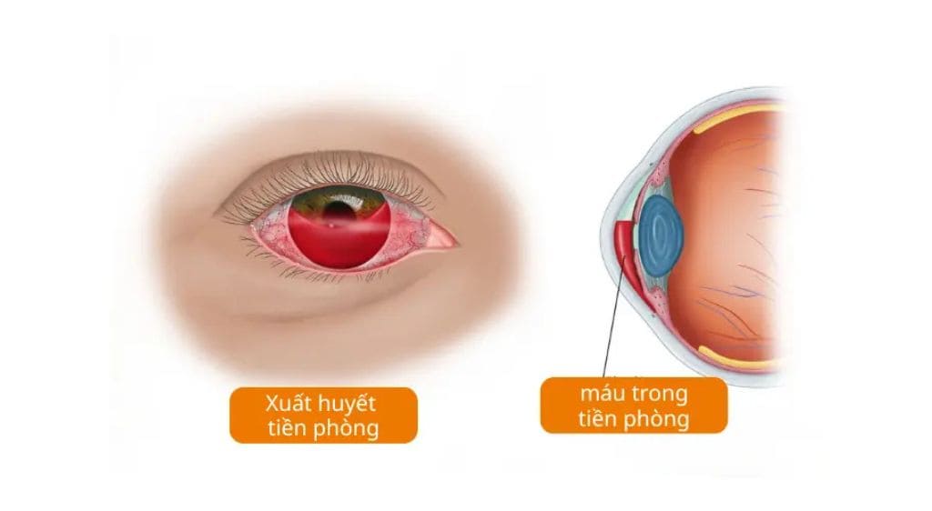 Xuất huyết tiền phòng mức độ 3 sẽ khiến lượng máu lấp đầy gần hết tiền phòng