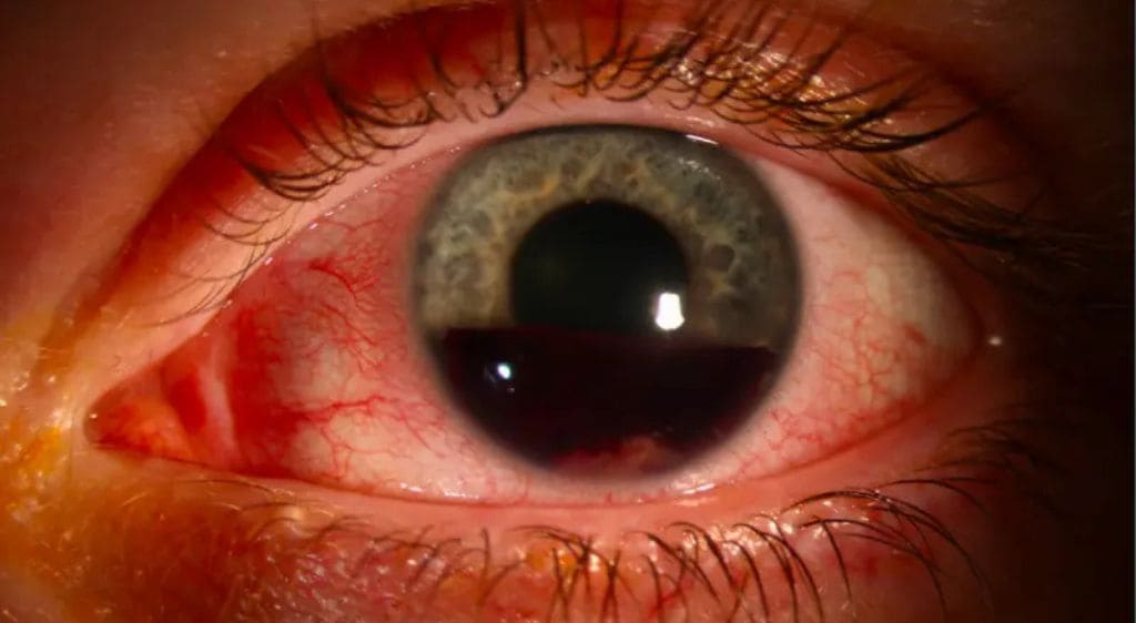 Xuất huyết tiền phòng sẽ khiến máu tụ lại ở lòng đen của mắt