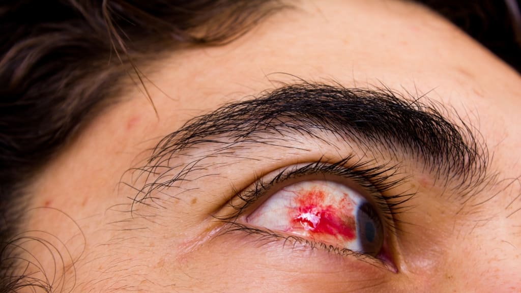 Xuất huyết trong dịch kính tạo ra đám đục, giảm độ trong dịch kính