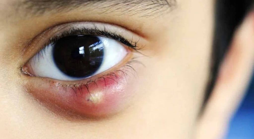 Ăn phải nhóm thực phẩm dễ gây dị ứng có thể gây mưng mủ