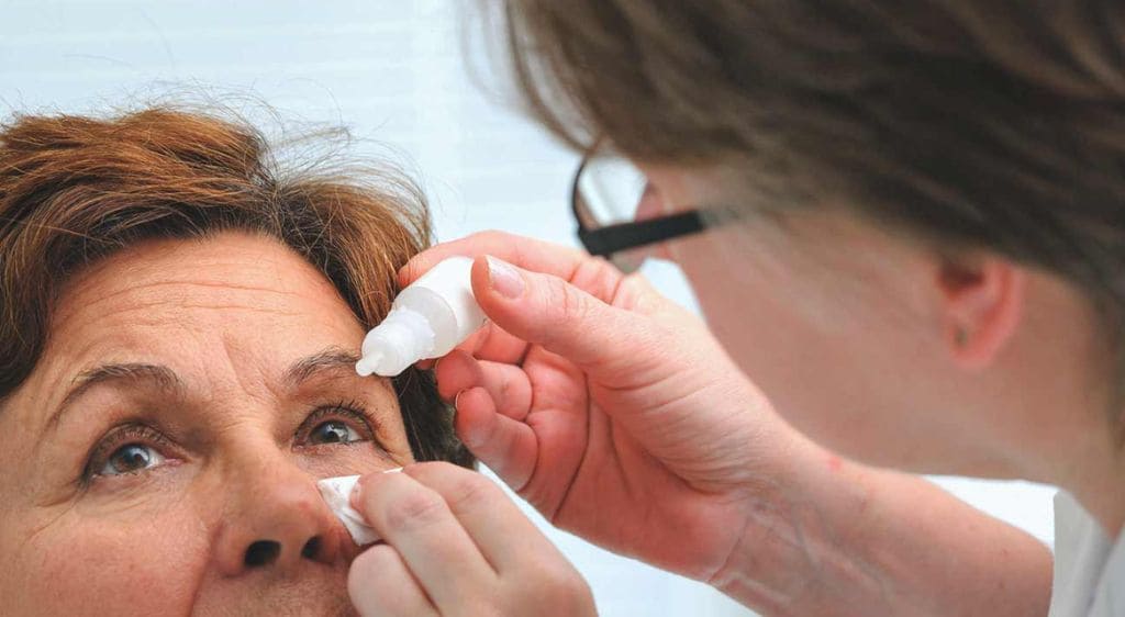 Bệnh nhân viêm giác mạc nên vệ sinh mắt theo chỉ dẫn của bác sĩ để hạn chế nguy cơ lây lan