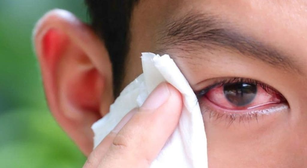 Biến chứng sẹo giác mạc có thể gây suy giảm thị lực vĩnh viễn