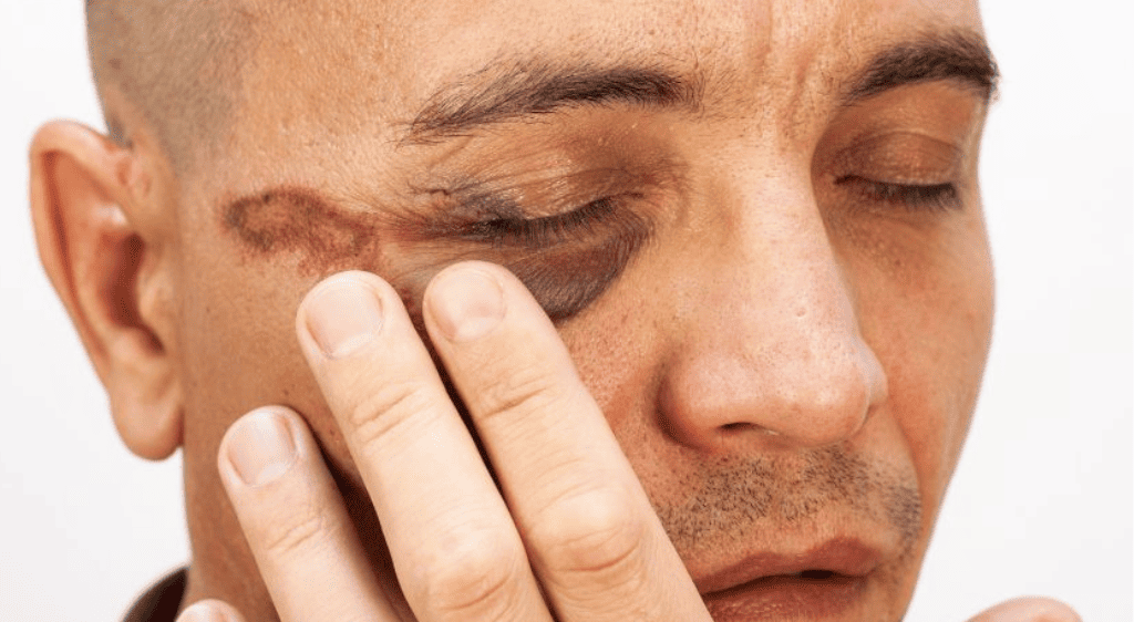 Các trường hợp tụ máu do chấn thương sẽ được chỉ định uống thuốc tan máu bầm mắt