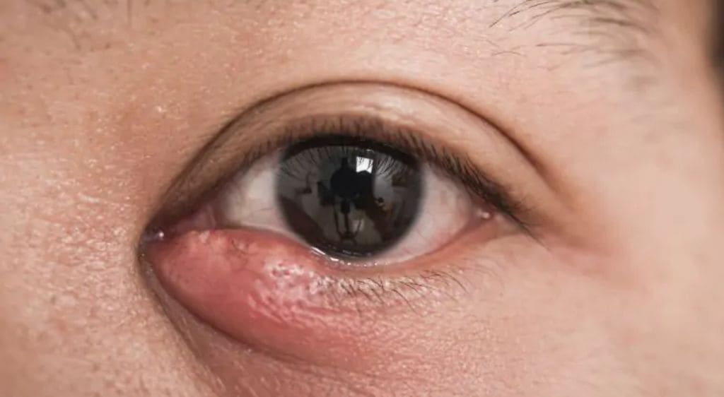 Chăm sóc tình trạng viêm đúng cách ngăn ngừa hình thành lẹo, chắp mắt