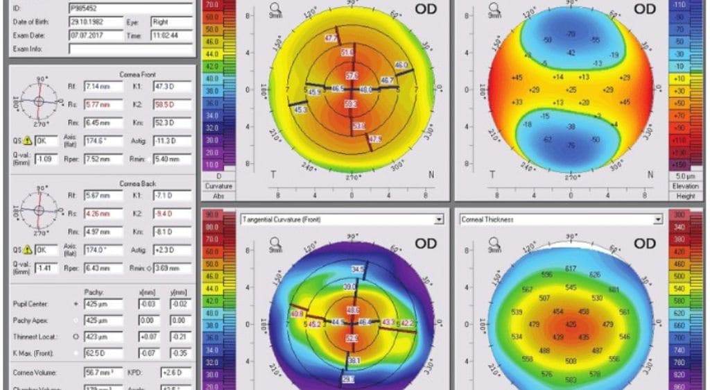 Chụp bản đồ giác mạc là kỹ thuật giúp tạo ra một bản đồ ba chiều chi tiết về bề mặt giác mạc