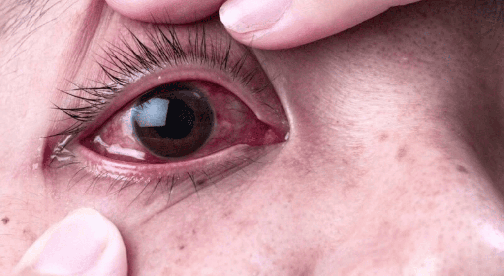 Đa số tình trạng đỏ mắt ở bệnh nhân sốt xuất huyết đều không quá nguy hiểm