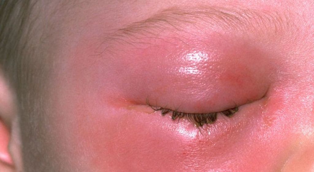 Dị ứng mắt gây ngứa dữ dội, sưng đỏ mắt và chảy nước mắt