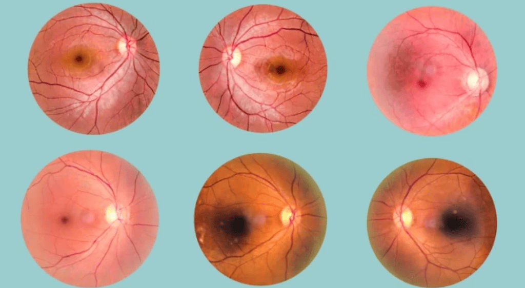 Đo thị trường mắt là tiêu chuẩn vàng giúp phát hiện sớm bệnh Glôcôm (cườm nước)