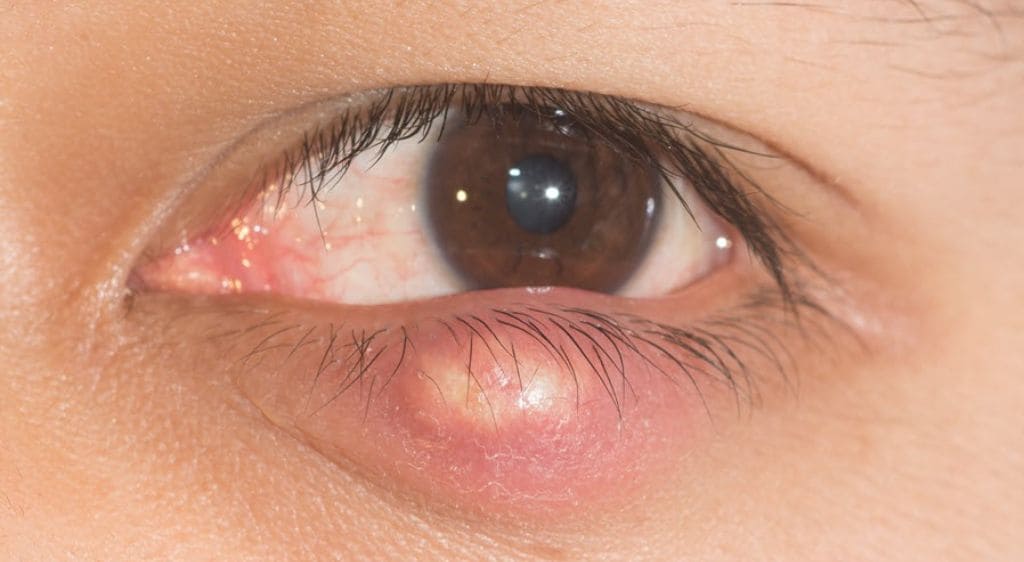 Lẹo và chắp gây ra khối u khó chịu ở mắt, làm cản trở tầm nhìn của người bệnh