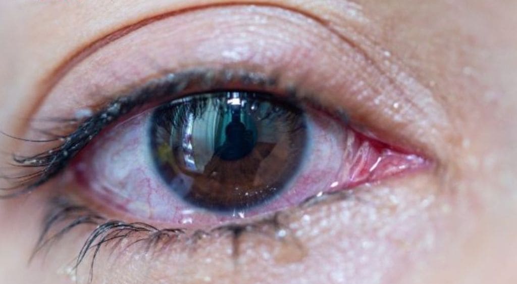 Mắt bị viêm nhiễm gây hiện tượng chảy nước mắt giàn giụa