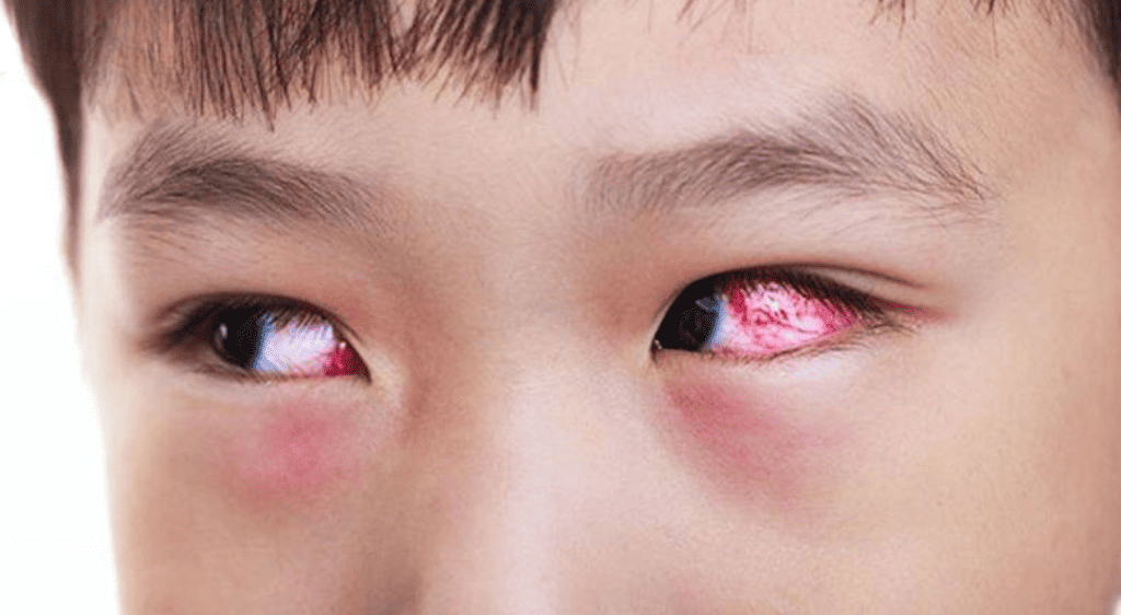 Mắt đỏ do sốt xuất huyết thường là tình trạng lòng trắng mắt có những mảng đỏ tươi