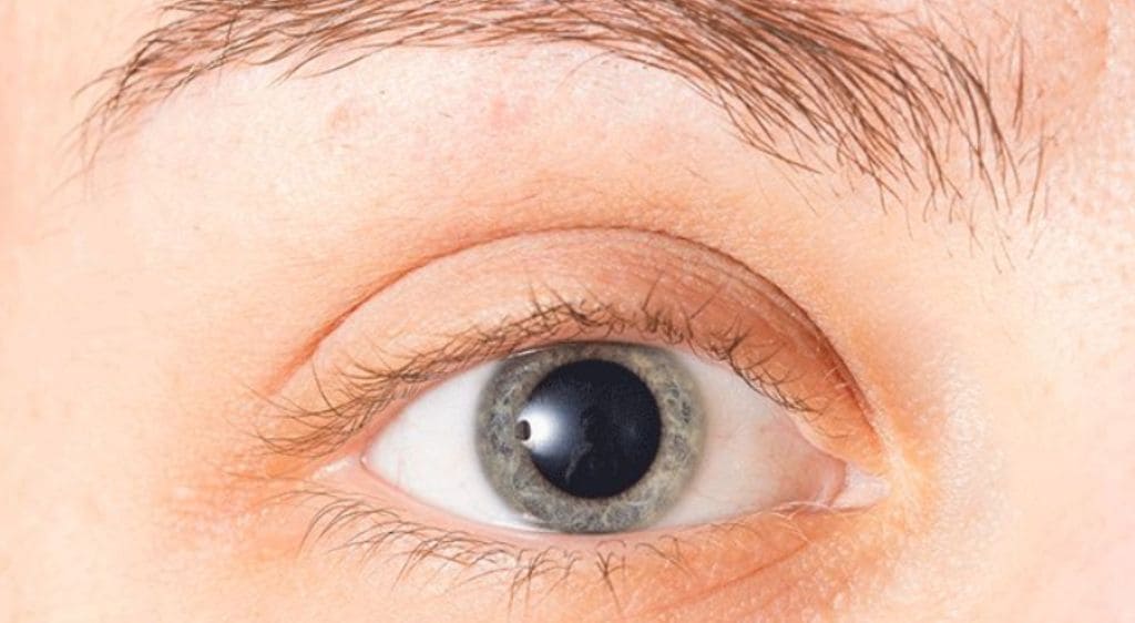 Mắt người sau khi sử dụng thuốc giãn đồng tử