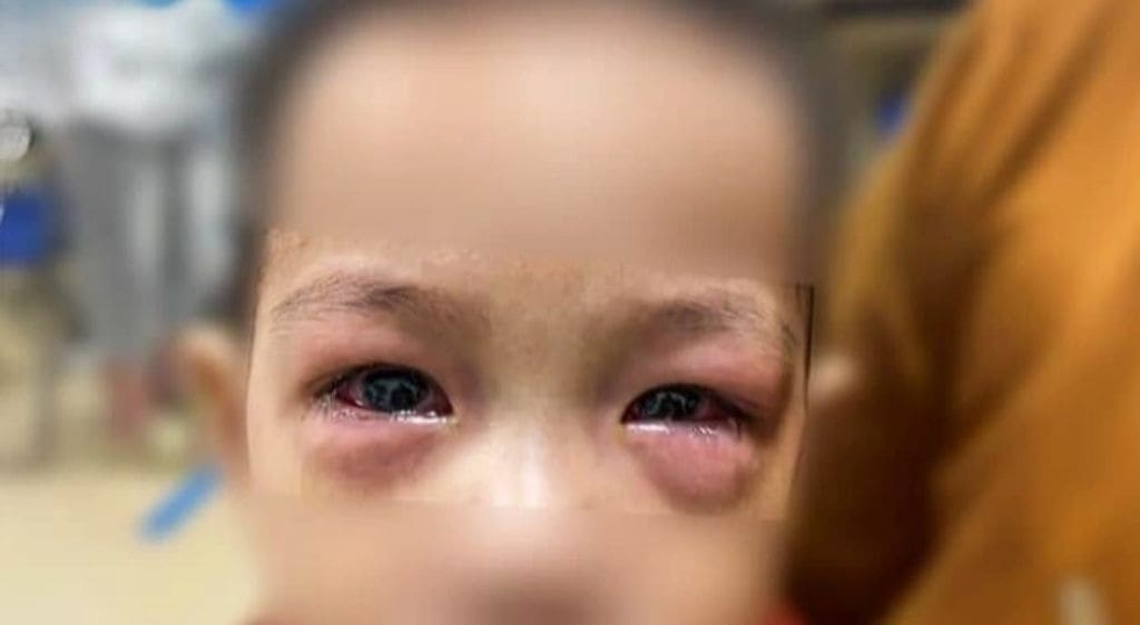 Mí mắt của người bệnh thường sưng to, mọng đỏ