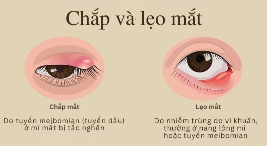 Nếu không được điều trị đúng cách, viêm bờ mi mắt có thể biến chứng thành chắp và lẹo mắt