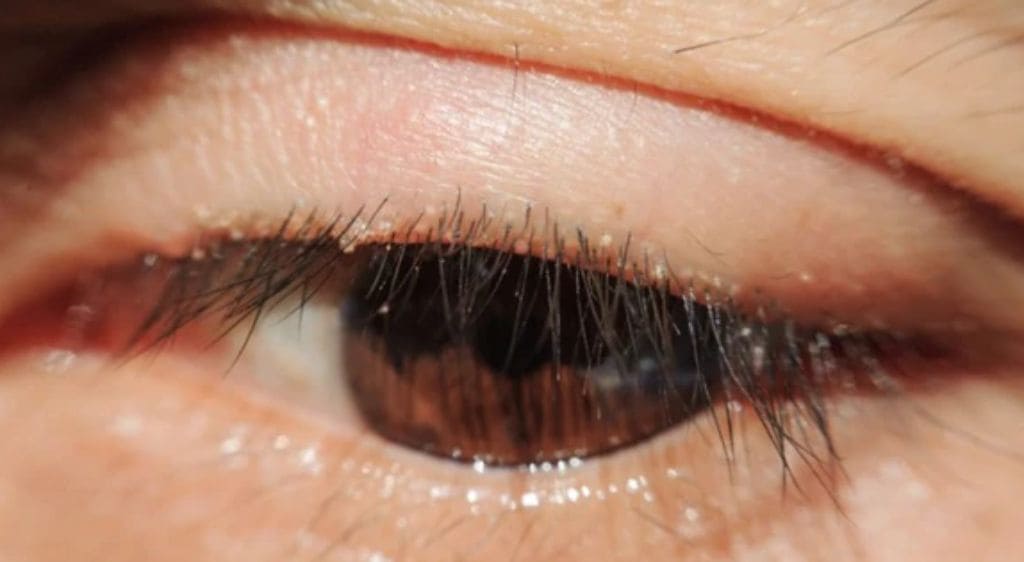 Rận mi là có thể lây lan khi dùng chung đồ cá nhân