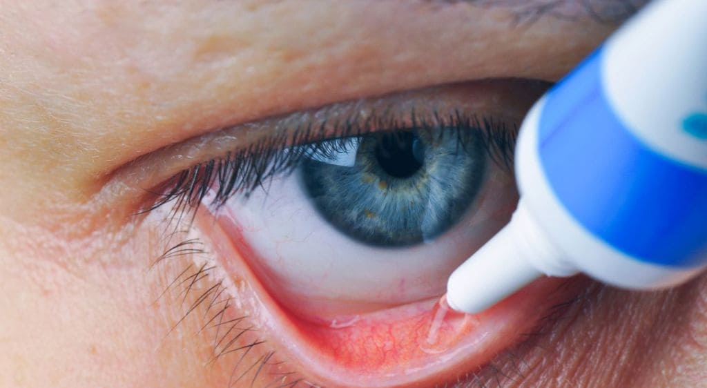 Sử dụng các loại thuốc mỡ kháng sinh tra mắt để điều trị nhiễm khuẩn nặng