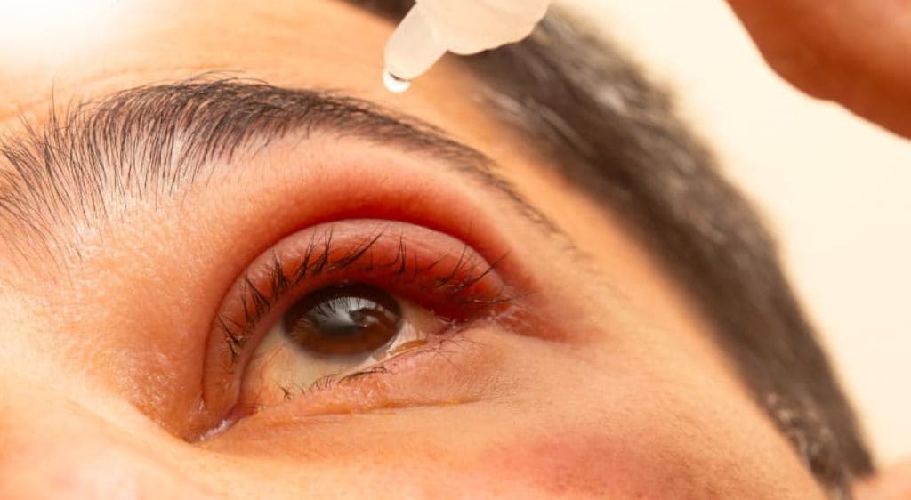 Sử dụng thuốc nhỏ mắt chứa steroid ngắn hạn giúp giảm viêm hiệu quả