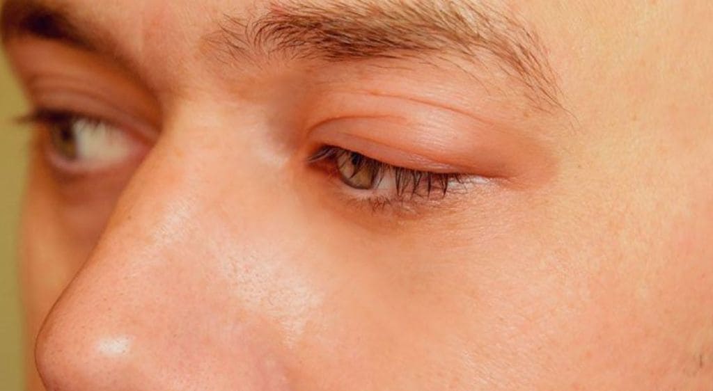 Sưng nề mí mắt chính là dấu hiệu của biến chứng viêm xoang ảnh hưởng đến mắt