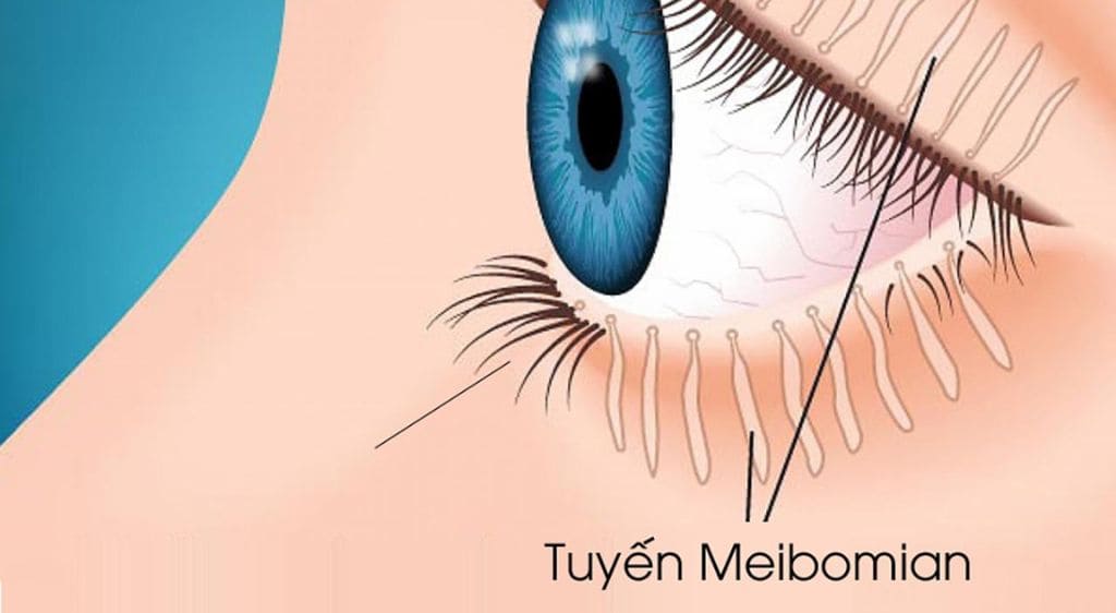Tắc nghẽn tuyến Meibomian gây viêm bờ mí mắt dưới
