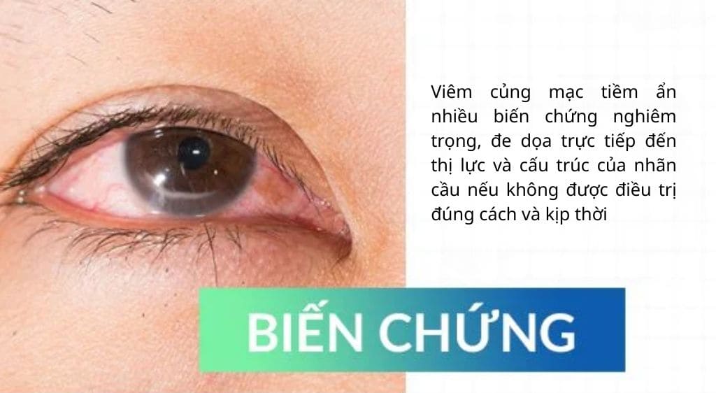 Tình trạng viêm củng mạc có thể lan sang giác mạc, gây ra viêm giác mạc