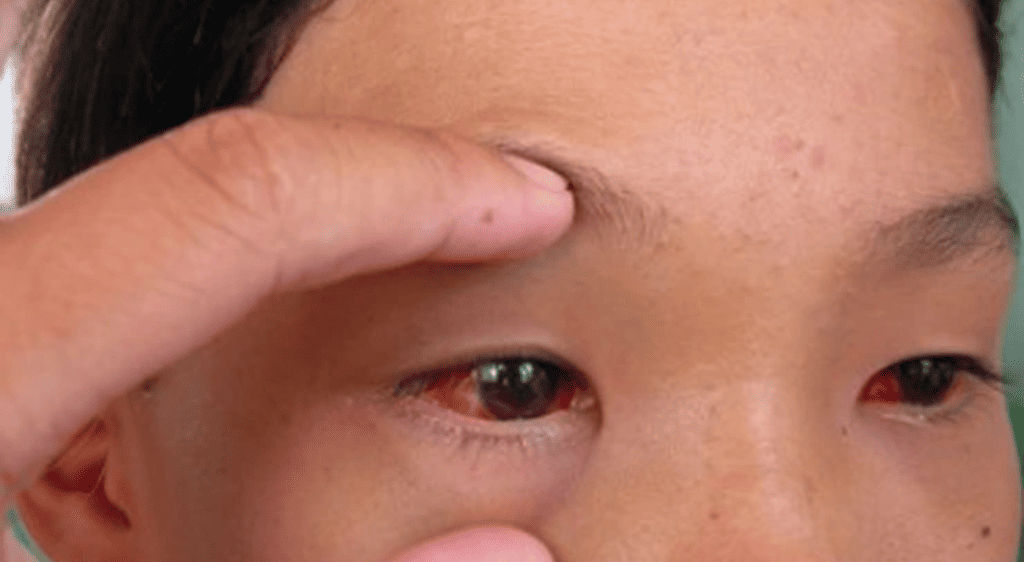 Tình trạng xuất huyết dưới kết mạc dẫn đến bị đỏ mắt khi bị sốt xuất huyết