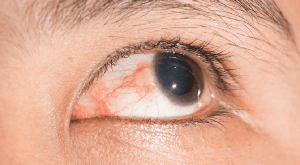 Tổn thương mạch máu trong mắt do sốt xuất huyết có thể khiến mắt bị mờ