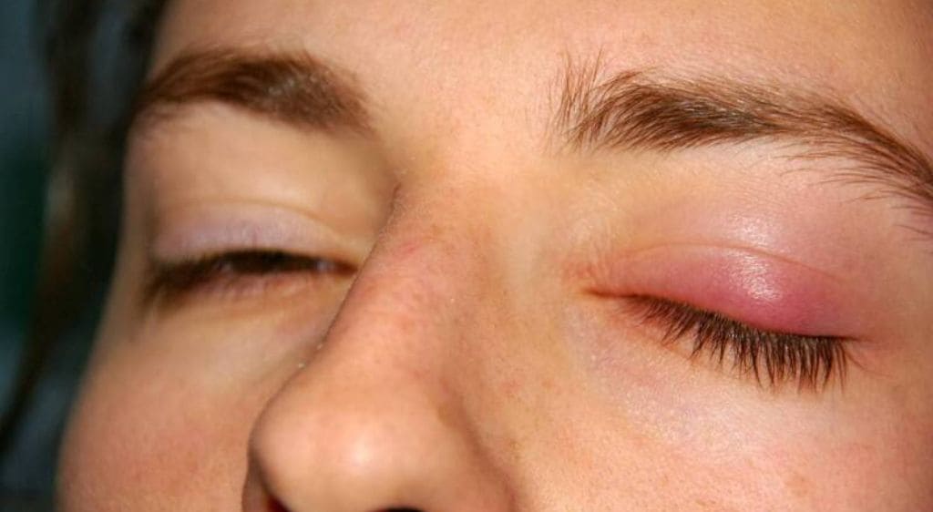 Viêm bờ mi mắt gây sưng đỏ, ngứa ngáy và làm mắt nhìn mờ thoáng qua do khô mắt