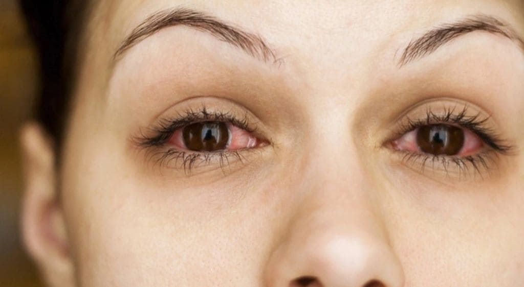Viêm củng mạc gây ra đau mắt, đỏ mắt kéo dài