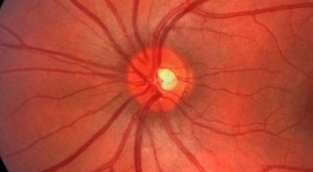 Viêm dây thần kinh thị giác xảy ra do tổn thương bao myelin của dây thần kinh dẫn truyền tín hiệu từ mắt lên não