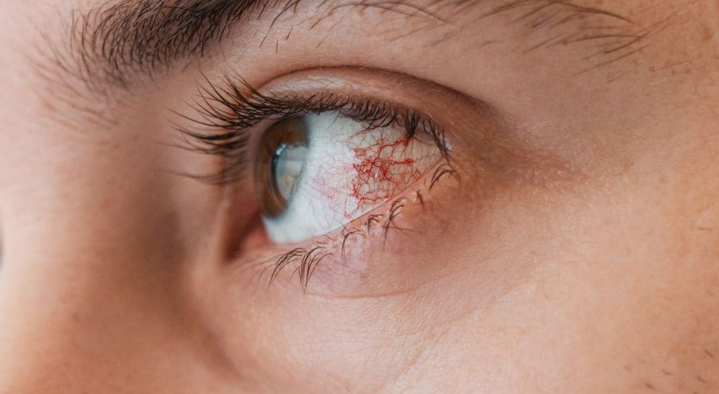 Viêm giác mạc cần ăn uống kiêng cữ theo chỉ định của bác sĩ