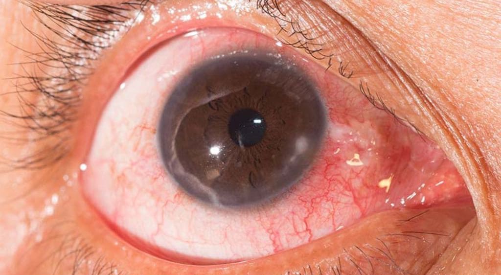 Viêm giác mạc là bệnh lý ở mắt phổ biến