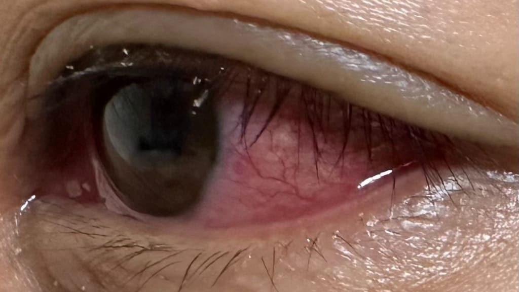 Viêm giác mạc thường xảy ra do các loại virus và nấm gây ra