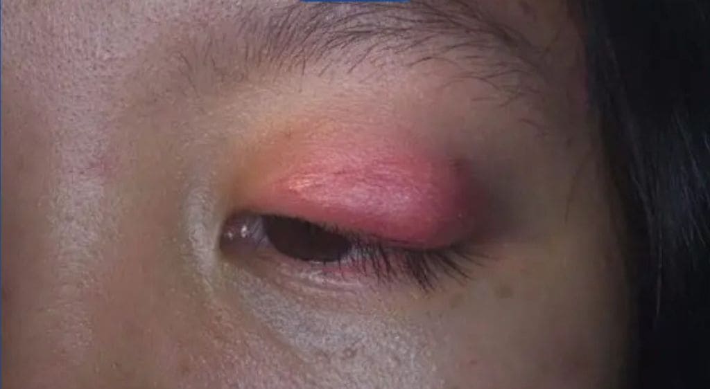 Viêm hốc mắt trước vách gây nhiễm trùng ở phần mi mắt và các mô xung quanh